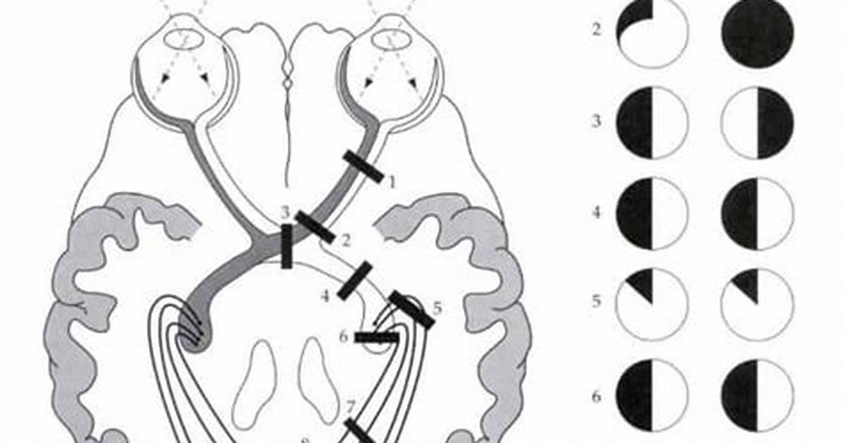 Bilateral Hemianopia