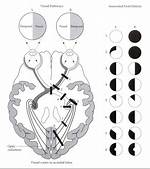 Bilateral Hemianopia