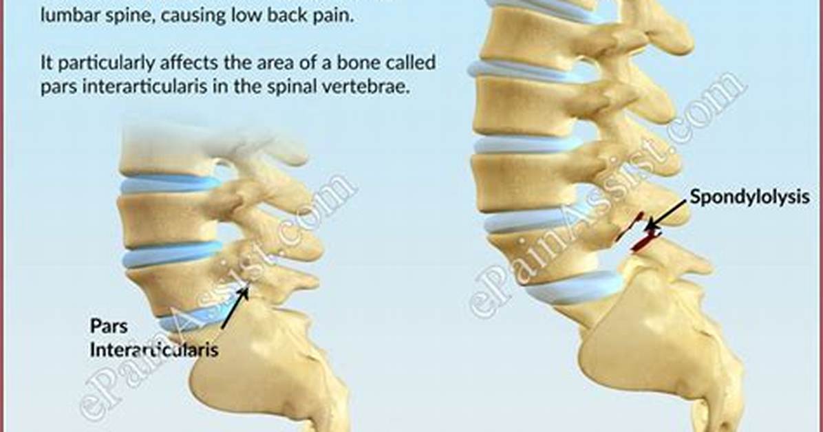 Bilateral Pars Defect