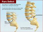 Bilateral Pars Defect