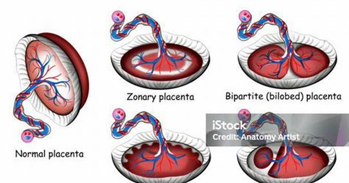 Bilobe Placenta