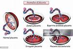 Bilobe Placenta