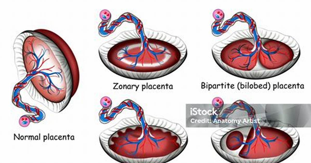 Bilobed Placenta