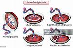 Bilobed Placenta