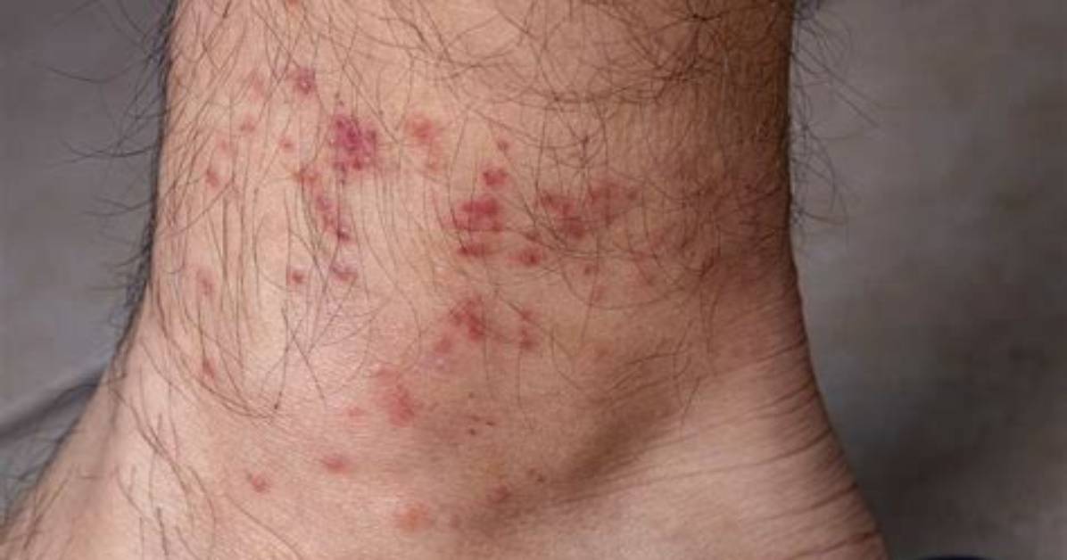 Bird Mite Bites