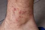 Bird Mite Bites