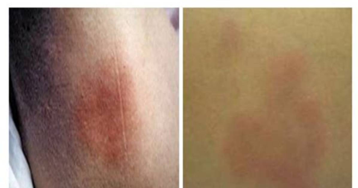 Blanchable Skin