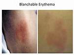 Blanchable Skin