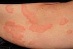 Blanching Rash