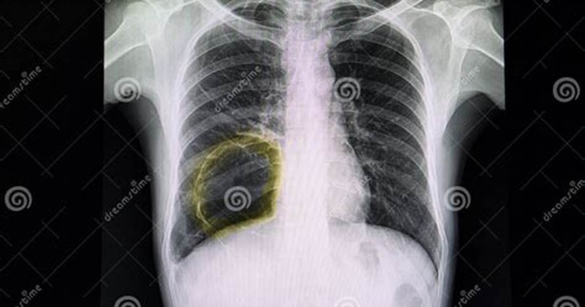 Bleb Lung
