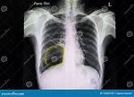 Bleb Lung