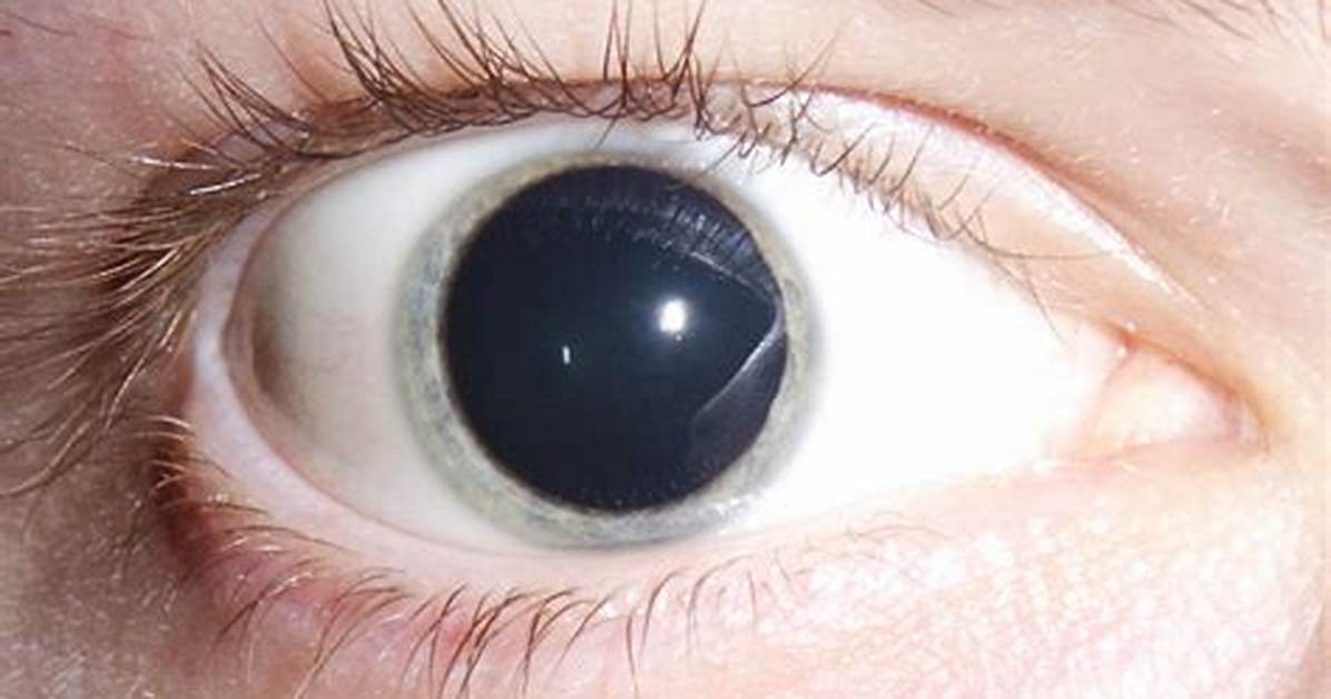 Blown Pupil