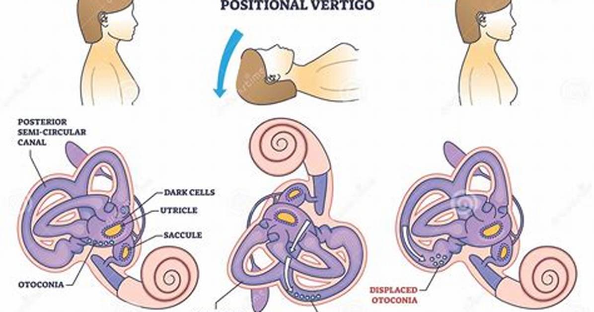 Bppv Icd 10