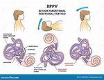 Bppv Icd 10