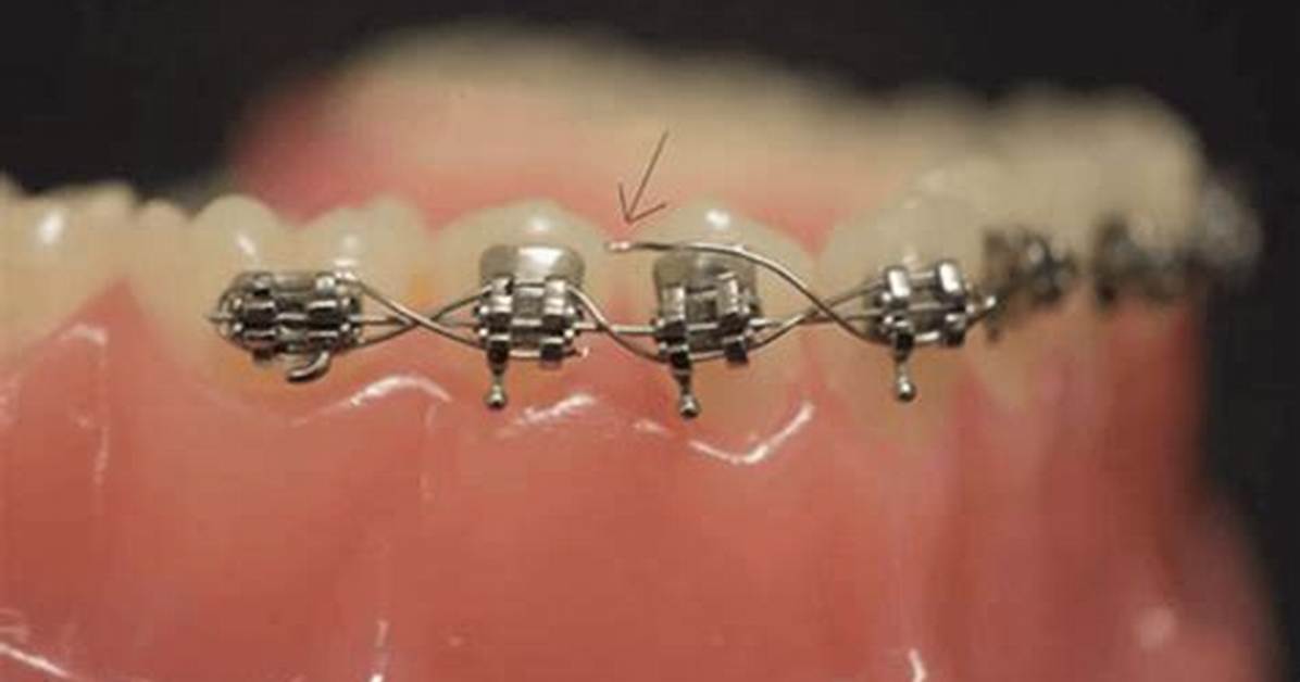 Broken Bracket Braces
