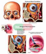 Broken Eye Socket