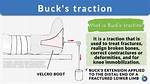 Bucks Traction: a Comprehensive Guide