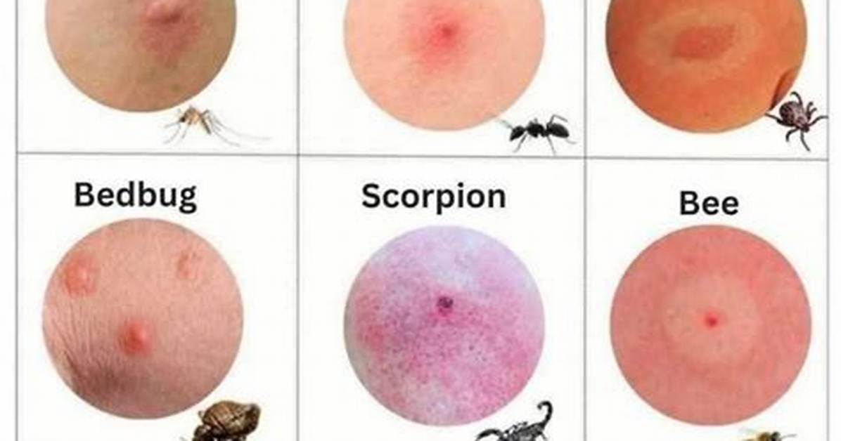 Bug Bite with White Head