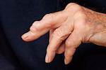 Bump on Knuckle