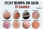 Bumps on the Complexion
