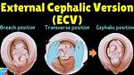 Can a Ecv Trigger Labour?