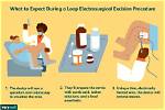 Can a Loop Excision Affect Pregnancy?