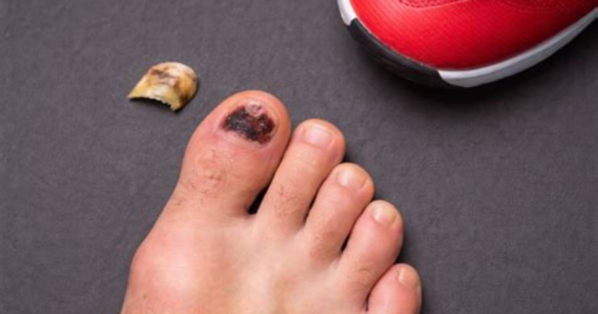 Can a Toe Fall off?