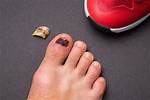 Can a Toe Fall off?