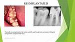 Can a Tooth Be Reimplanted?
