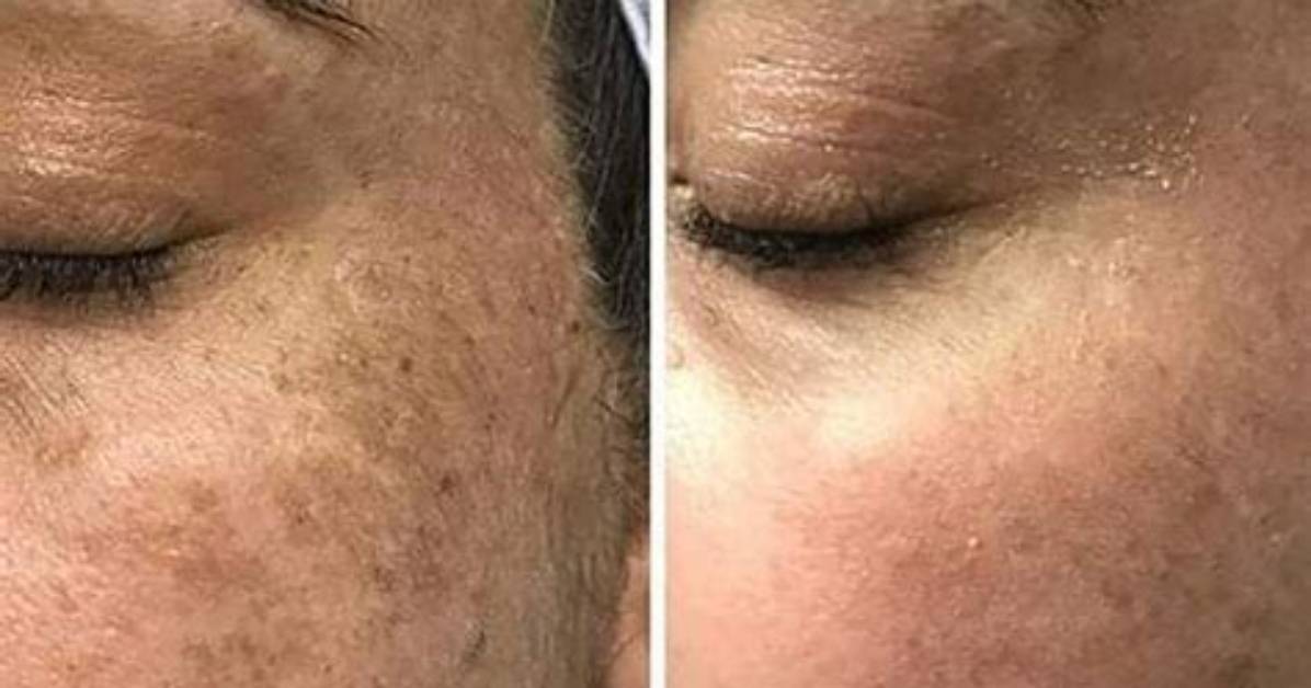 Can Bleach Remove Pigmentation