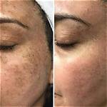 Can Bleach Remove Pigmentation