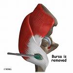 Can Bursitis Return After Bursectomy?