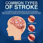 Can Cause a Stroke?