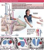 Can Cavernomas Cause Headaches?
