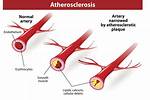Can Claudication Be Cured?