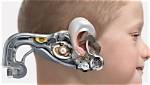 Can Cochlear Implants Be Removed?