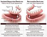 Can Dentures Be Fixed?