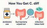 Can Difficile Kill You?