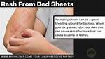 Can Dirty Sheets Cause Itching?