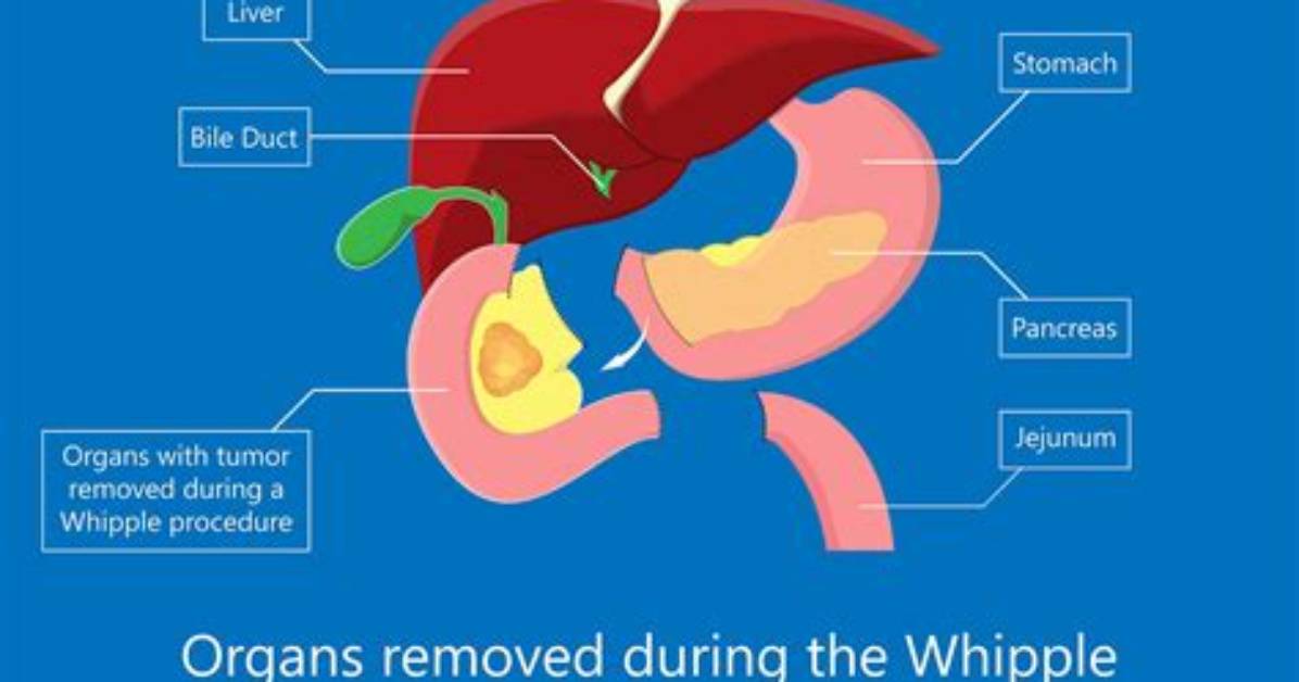 Can Duodenum Be Removed?