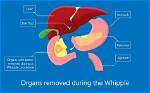 Can Duodenum Be Removed?