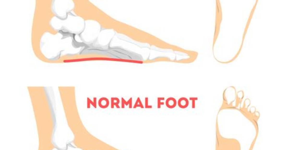 Can Flat Footed Get Drafted?