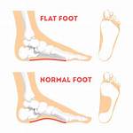Can Flat Footed Get Drafted?