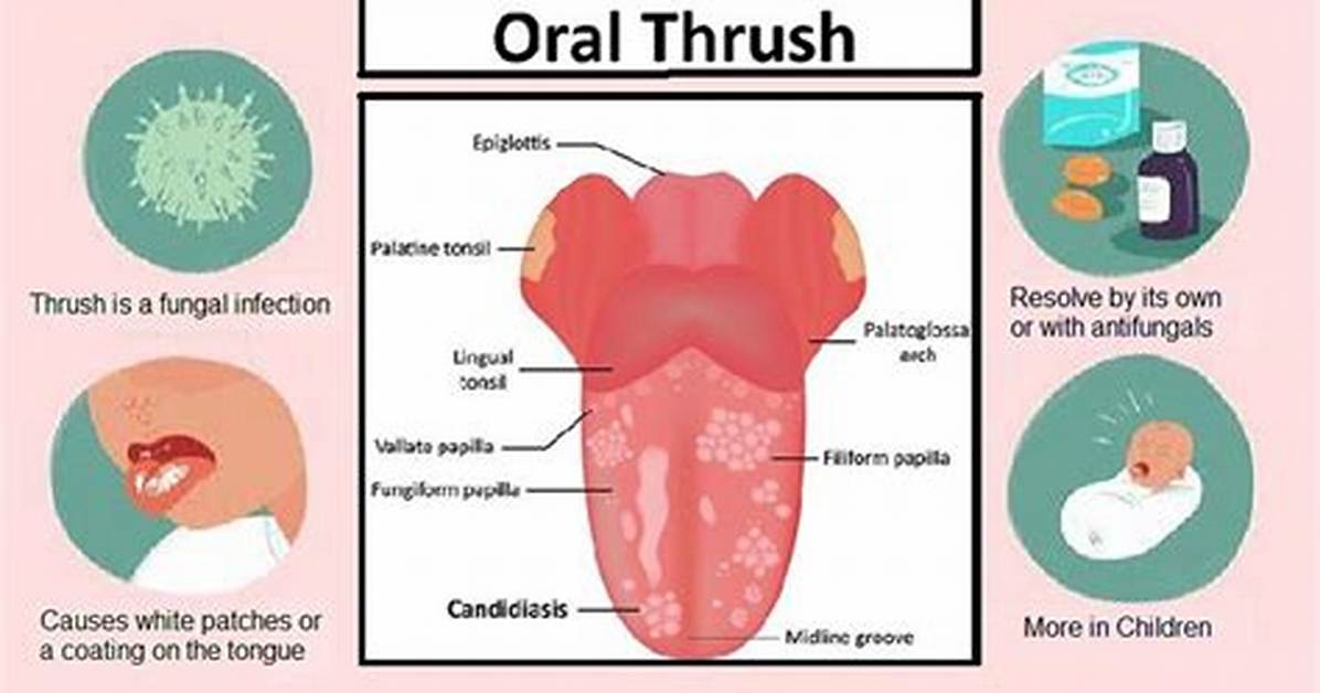 Can Fleurstat Cause Thrush?