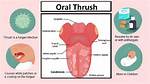 Can Fleurstat Cause Thrush?