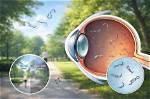 Can Floaters Affect Vision?