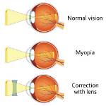 Can Myopia Cause Squint?