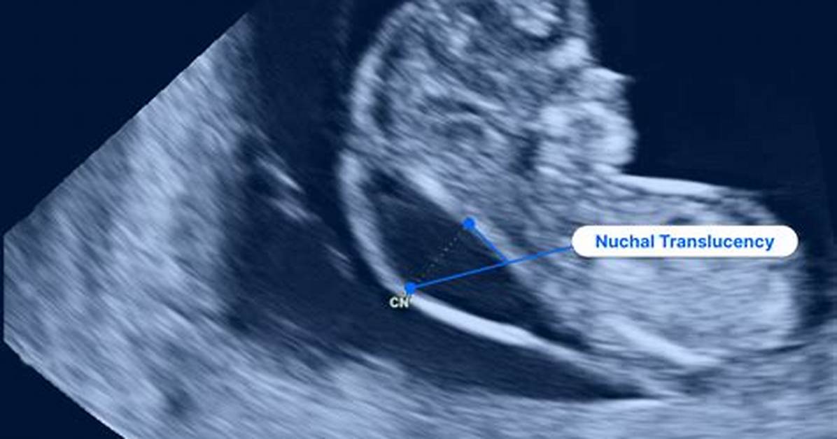 Can Nuchal Translucency Decrease?