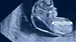 Can Nuchal Translucency Decrease?