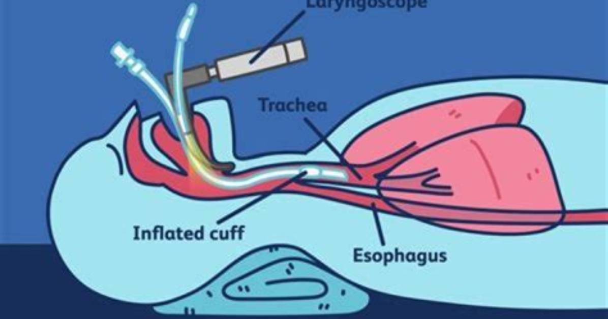 Can Nurses Do Extubation?